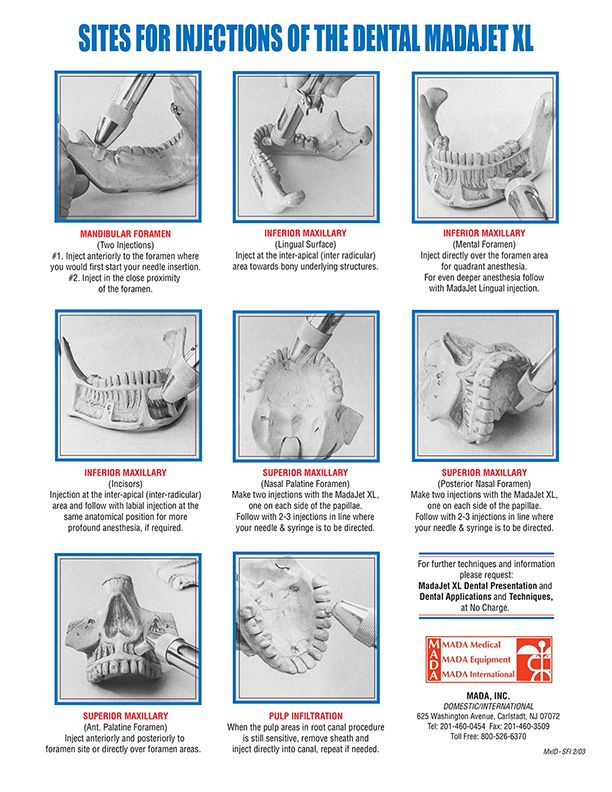 Dental MadaJet Sites For Injection